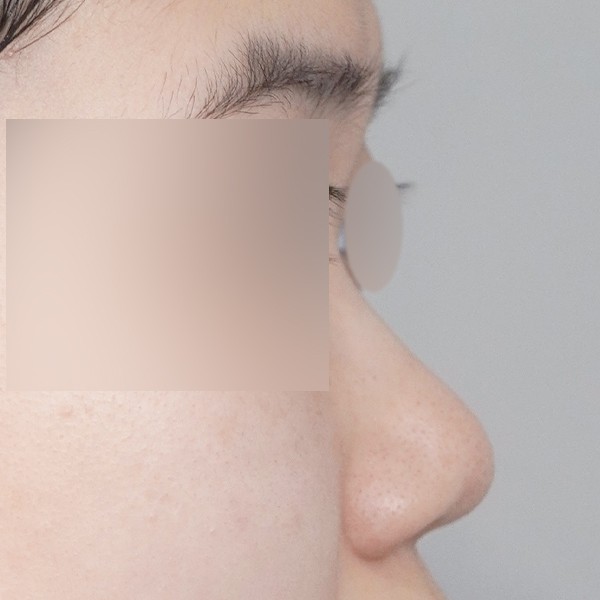 콧대,코끝,실리콘,비중격,귀연골,복코,짧은코